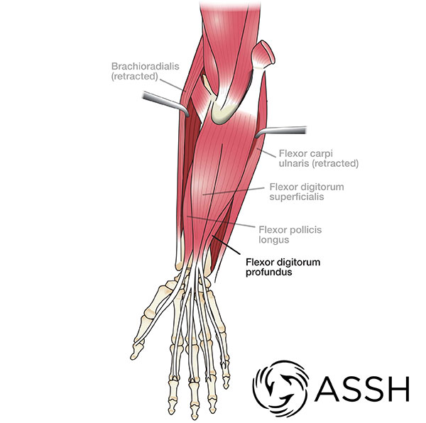 Symptoms And Treatments Of Flexor Tendon Injuries Gateway Sports And Rehab 7981